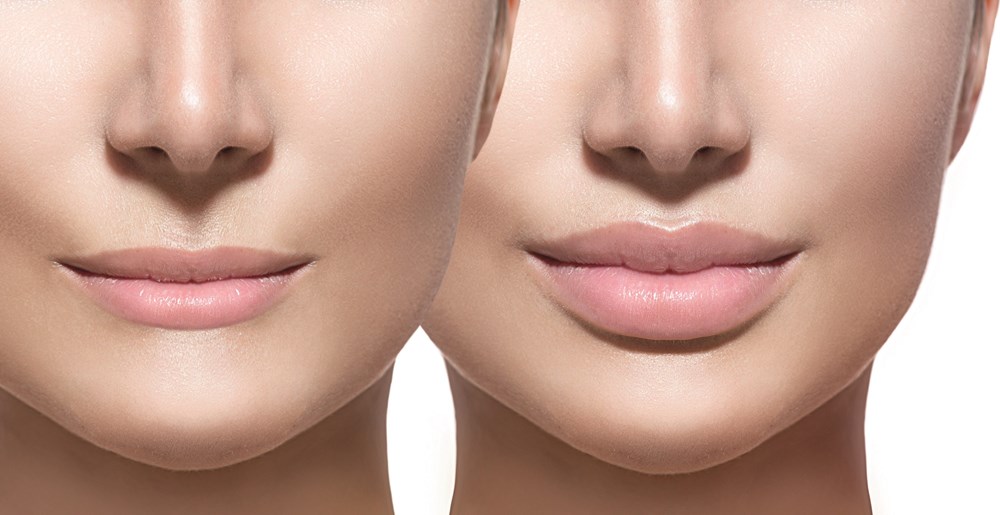 Lip Plumper - Ross Berry